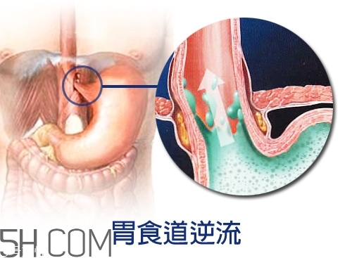 胃食道逆流怎么辦 質(zhì)子泵抑制劑風險高