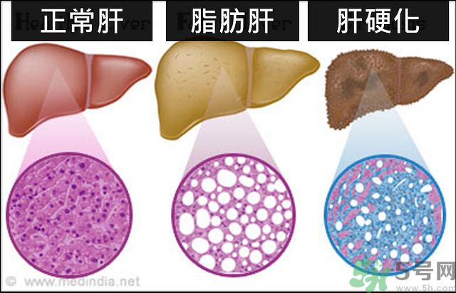 得了脂肪肝該怎么治？脂肪肝對(duì)人體危害有多大？