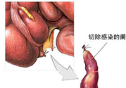 闌尾手術(shù)會(huì)影響結(jié)腸嗎？闌尾手術(shù)術(shù)后要注意什么？