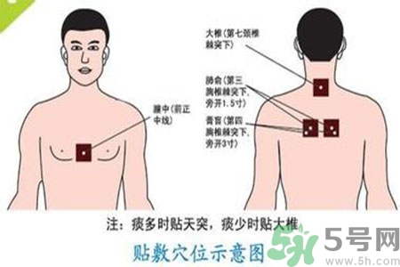 三伏貼能治頸椎病嗎？頸椎病三伏貼穴位