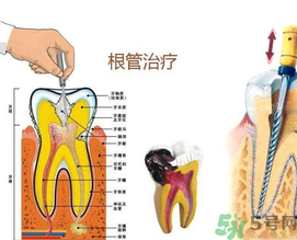 什么是根管治療？為什么牙齒疼要做根管治療？