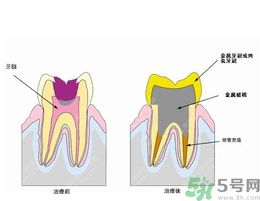 什么是根管治療？為什么牙齒疼要做根管治療？