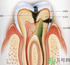 什么是根管治療？為什么牙齒疼要做根管治療？