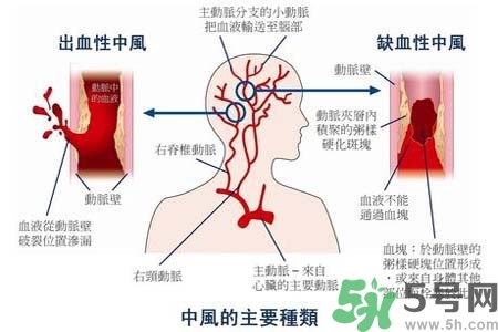 腦中風是什么？腦中風的癥狀？