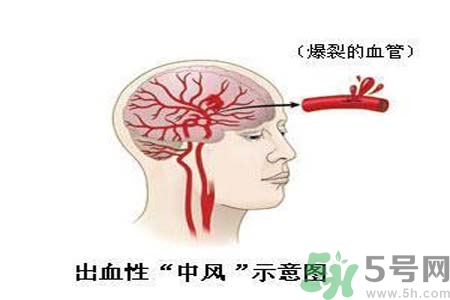 腦中風的護理措施？腦中風的飲食護理？