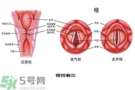 慢性咽炎是什么？慢性咽炎的癥狀有哪些？