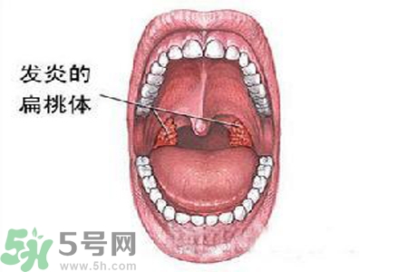 慢性咽炎是什么？慢性咽炎的癥狀有哪些？