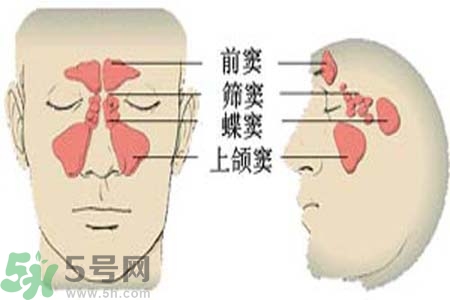 鼻竇炎是什么？鼻竇炎的癥狀有哪些？