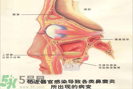 鼻竇炎是什么？鼻竇炎的癥狀有哪些？