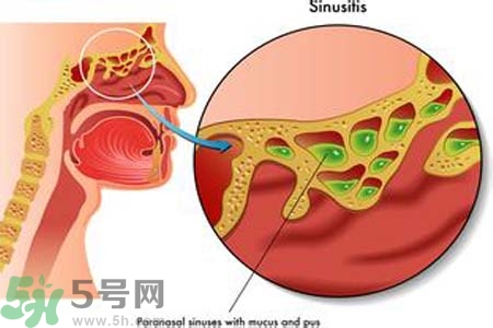 鼻竇炎的護(hù)理措施？鼻竇炎的飲食護(hù)理？