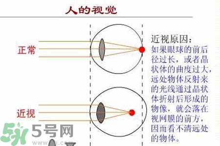 近視眼的發(fā)病因素？近視眼的并發(fā)癥有哪些？