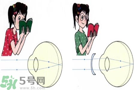 近視眼的發(fā)病因素？近視眼的并發(fā)癥有哪些？