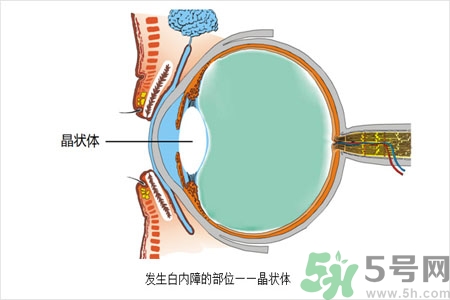 白內(nèi)障的護理措施是什么？白內(nèi)障的飲食護理有哪些？