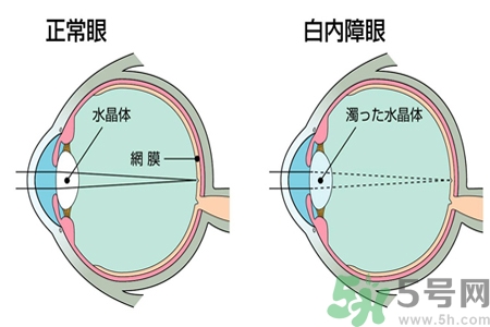 白內(nèi)障的發(fā)病因素是什么？白內(nèi)障并發(fā)癥有哪些？