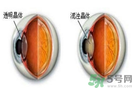 白內(nèi)障治療方法是什么？白內(nèi)障可以用什么藥物治療？