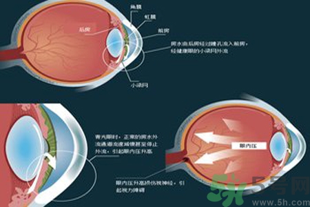 青光眼是什么？青光眼癥狀有什么？