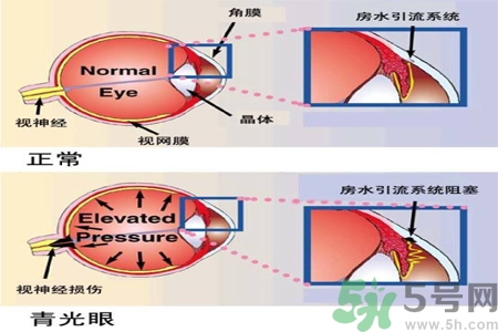 青光眼的護(hù)理措施有什么？青光眼的飲食護(hù)理有哪些？