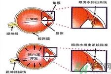 青光眼的發(fā)病因素是什么？青光眼的并發(fā)癥有哪些？