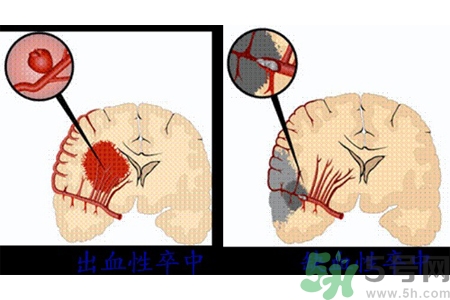 腦出血的發(fā)病因素是什么？腦出血的并發(fā)癥有哪些？