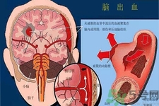 腦出血的發(fā)病因素是什么？腦出血的并發(fā)癥有哪些？