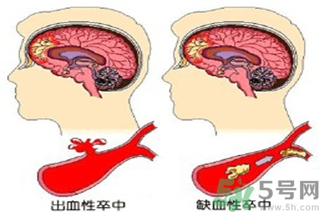 腦出血的治療方法是什么？腦出血可以用哪些藥物治療？