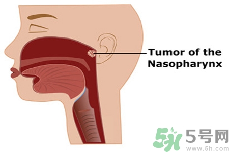 鼻咽癌的日常措施是什么？鼻咽癌注意的飲食有哪些？