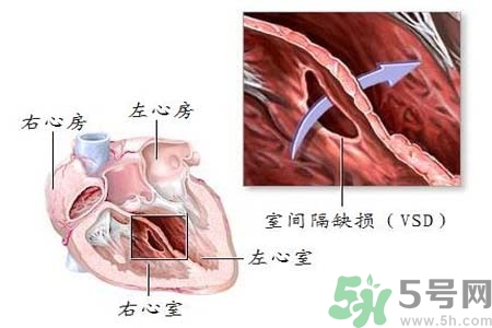 先天性心臟病是什么？先天性心臟病的癥狀有哪些？