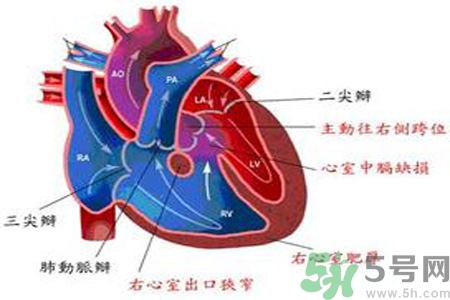 先天性心臟病發(fā)病原因是什么？