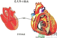 先天性心臟病發(fā)病原因是什么？