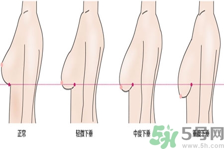 ?女性乳房下垂的原因是什么？女性乳房下垂的分類有哪些？