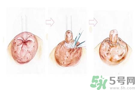 乳頭內(nèi)陷怎么回事？乳頭內(nèi)陷的原因是什么？