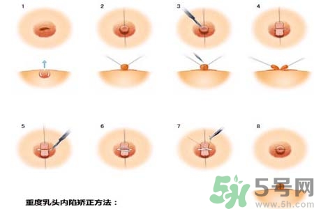 乳頭內(nèi)陷怎么回事？乳頭內(nèi)陷的原因是什么？