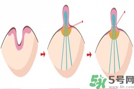 乳頭內(nèi)陷怎么辦？乳頭內(nèi)陷的癥狀有哪些？