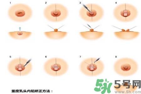 乳頭內(nèi)陷怎么辦？乳頭內(nèi)陷的癥狀有哪些？