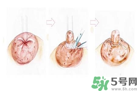 乳頭內(nèi)陷怎么辦？乳頭內(nèi)陷的癥狀有哪些？