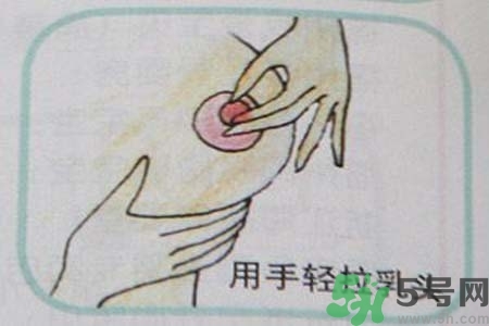 乳頭內(nèi)陷怎么辦？乳頭內(nèi)陷的癥狀有哪些？