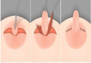 乳頭內(nèi)陷怎么辦？乳頭內(nèi)陷的癥狀有哪些？