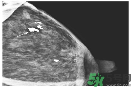 乳腺增生鈣化是什么？乳腺鈣化的癥狀有哪些？