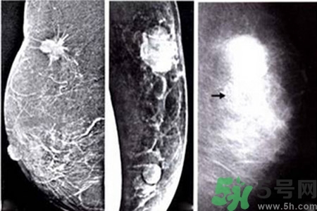 乳腺增生鈣化是什么？乳腺鈣化的癥狀有哪些？