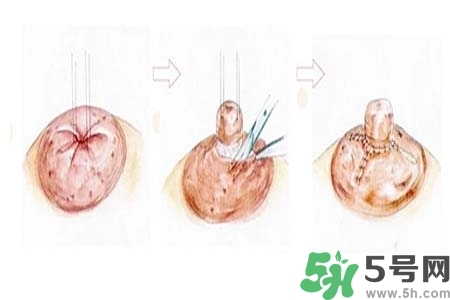 乳頭內(nèi)陷怎么矯正？乳頭內(nèi)陷矯正方法是什么？