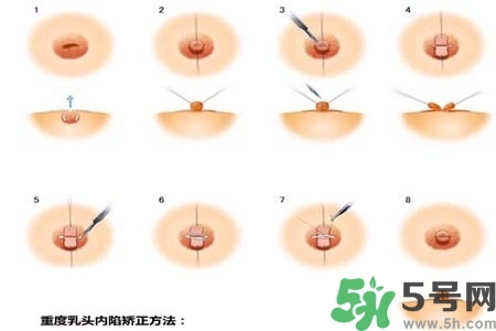 乳頭內(nèi)陷怎么矯正？乳頭內(nèi)陷矯正方法是什么？