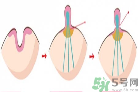 乳頭內(nèi)陷矯正需注意什么？乳頭內(nèi)陷如何預(yù)防？