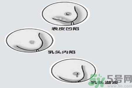 乳頭內(nèi)陷矯正需注意什么？乳頭內(nèi)陷如何預(yù)防？