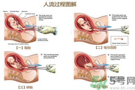 人工流產(chǎn)后多久可以再次懷孕？流產(chǎn)后需要注意什么？