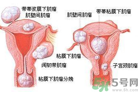 ?子宮移位怎么治療？子宮移位能懷孕嗎？