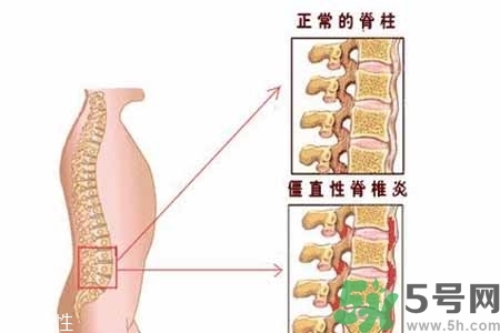 僵直性脊椎炎的癥狀有哪些？怎樣預(yù)防僵直性脊椎炎？