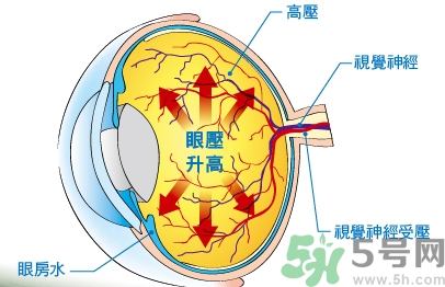 青光眼可以治愈嗎？青光眼怎樣治療？