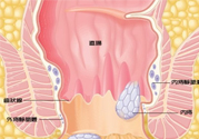 怎樣辨別外痔和內(nèi)痔？外痔和內(nèi)痔的區(qū)別