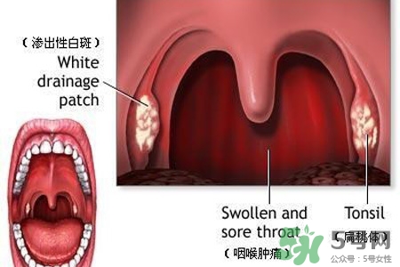 咽喉炎吃什么藥最好？咽喉炎吃什么藥好的快？