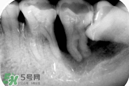 智齒會(huì)引起耳鳴嗎？耳鳴跟智齒有關(guān)系嗎？